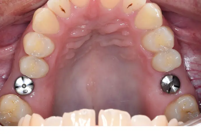 Cursus Implantologie