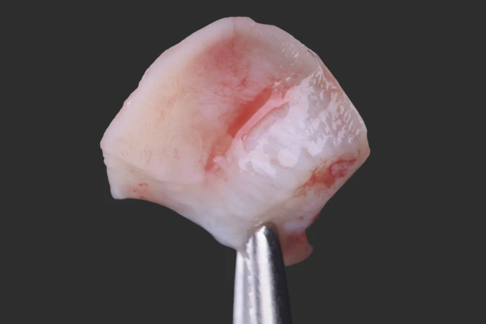 Chirurgie plastique péri-implantaire &amp; paro