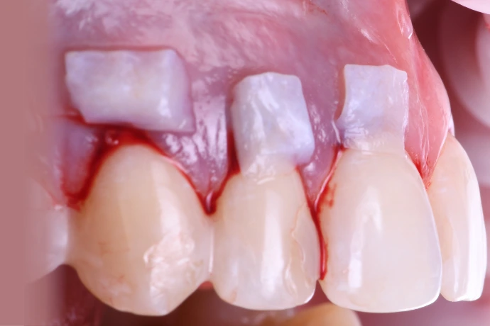 Chirurgie plastique péri-implantaire &amp; paro